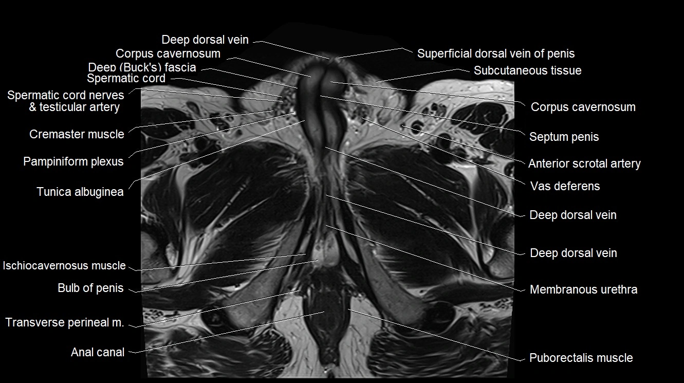 MRI 3T scrotum and penis axial cross sectional anatomy image 17.webp
